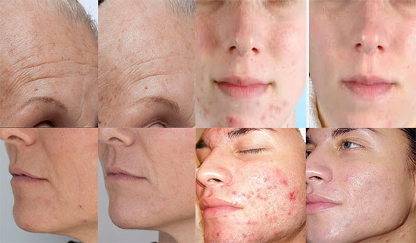 گاربردهای دستگاه میکرودرم ابریژن